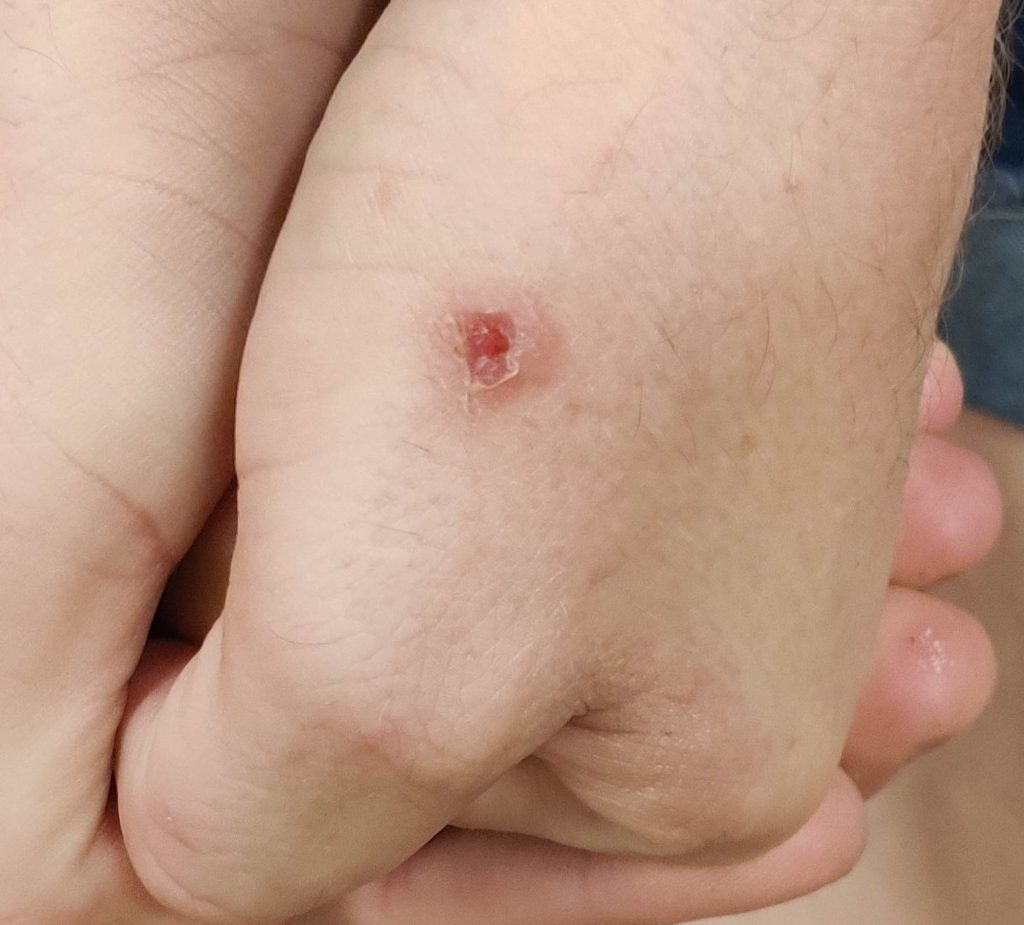 Healing ulcerative lesion on the left hand.