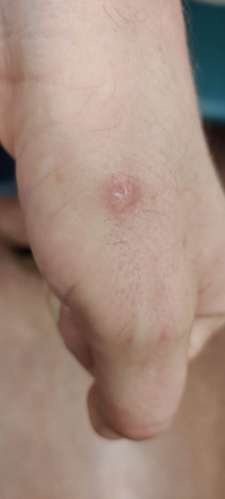 Nearly fully healed ulcerative lesion with mild residual desquamation on the left hand.