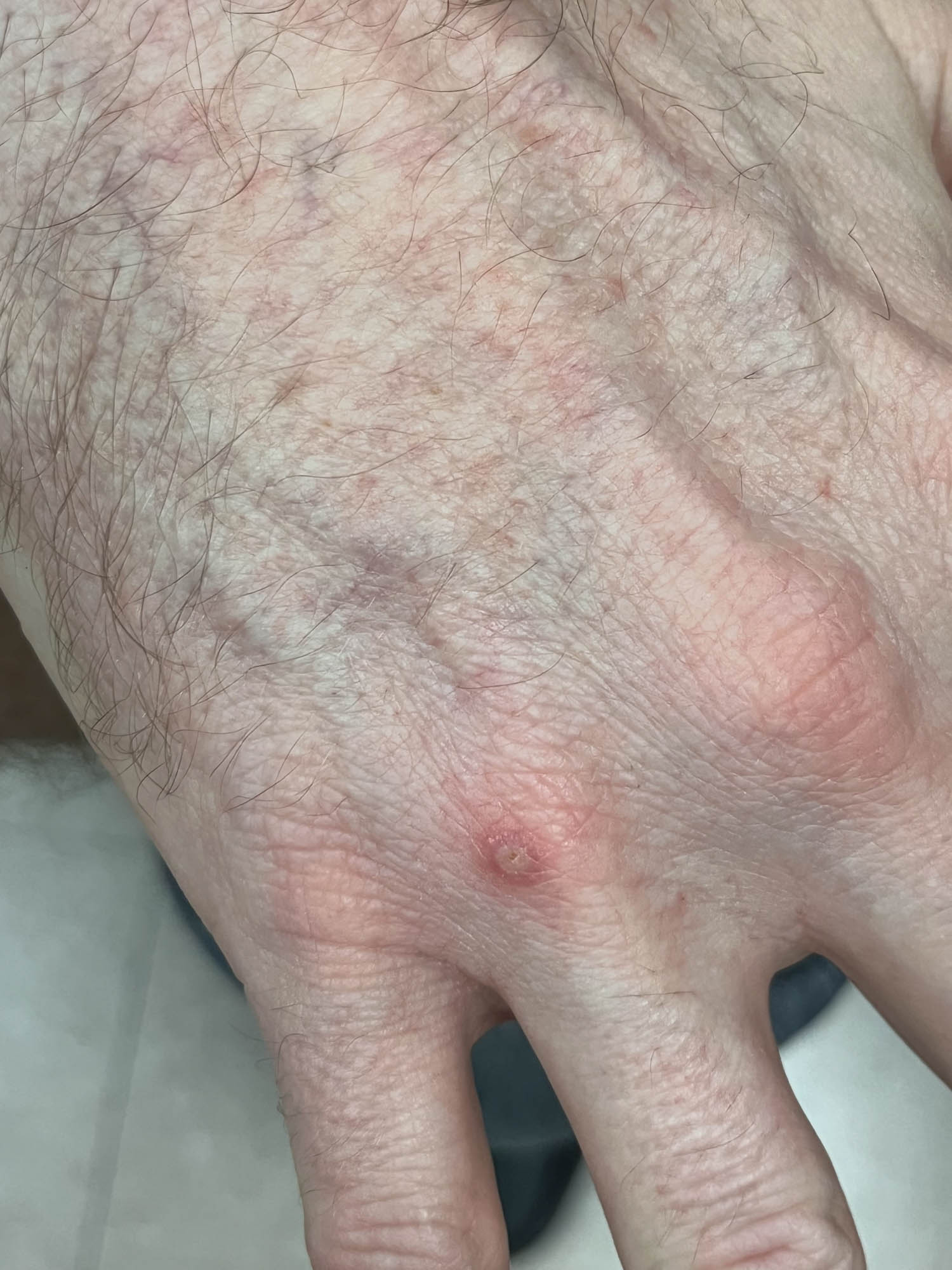 Pustular lesion on the right hand