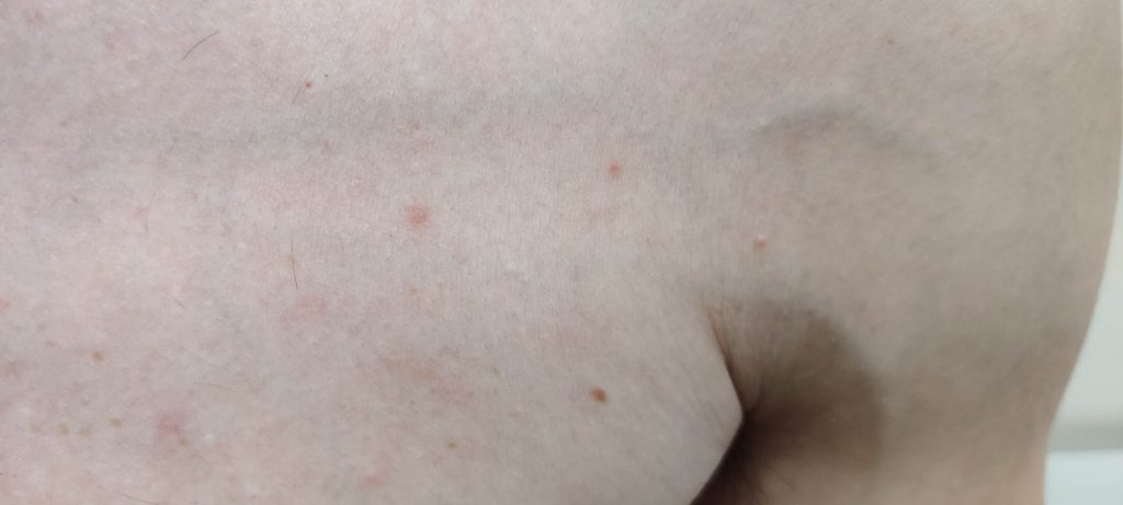 Small maculopapular lesions on back