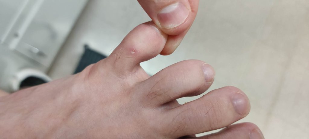 Small healing shallow ulcer on the dorsum of the toe.