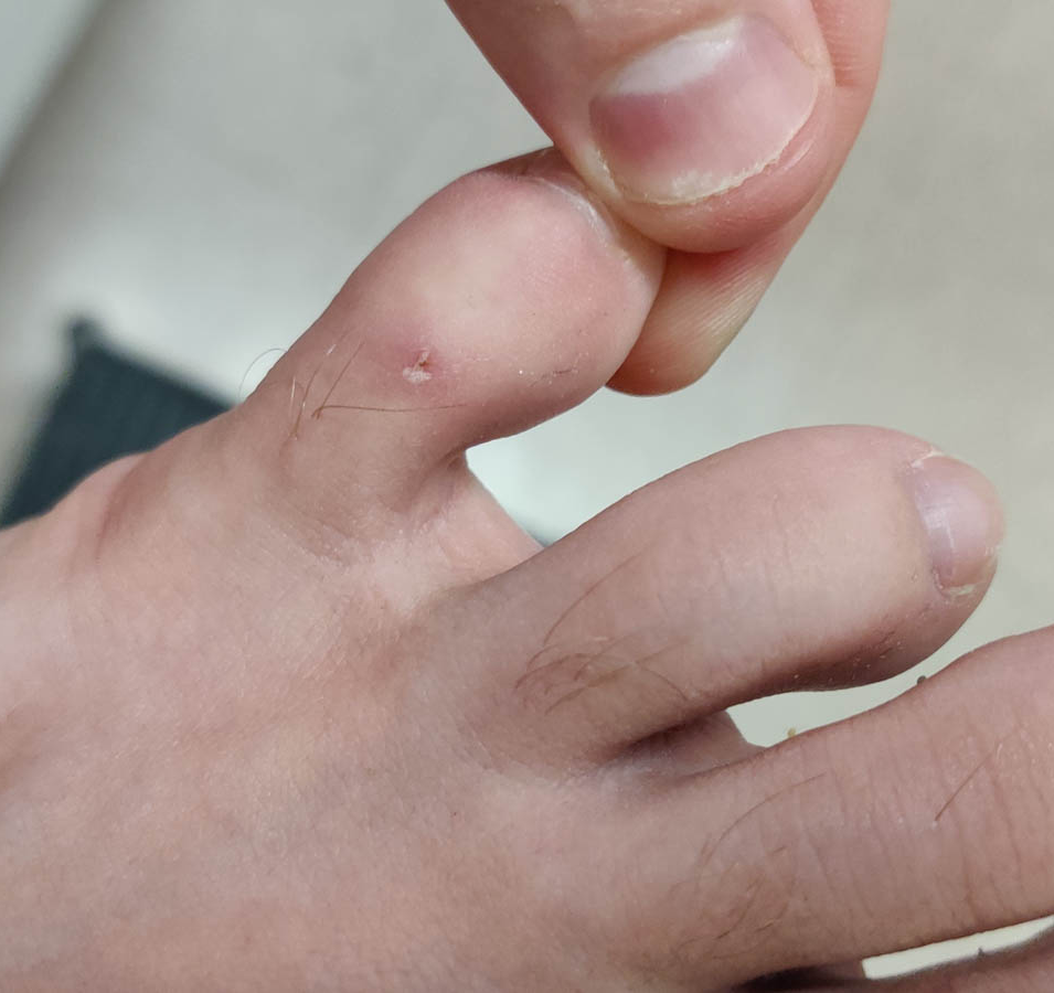 Small healing shallow ulcer on the dorsum of the toe.