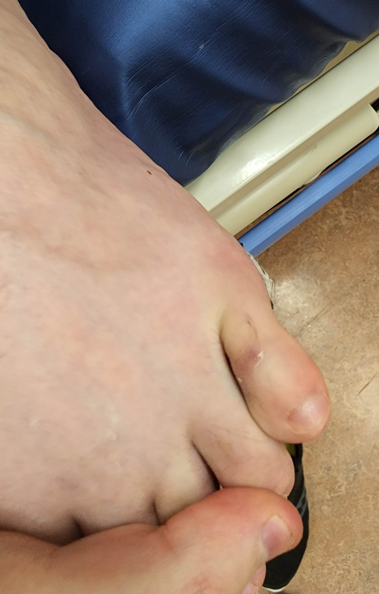 Nearly resolved shallow ulcer on the dorsum of the toe.