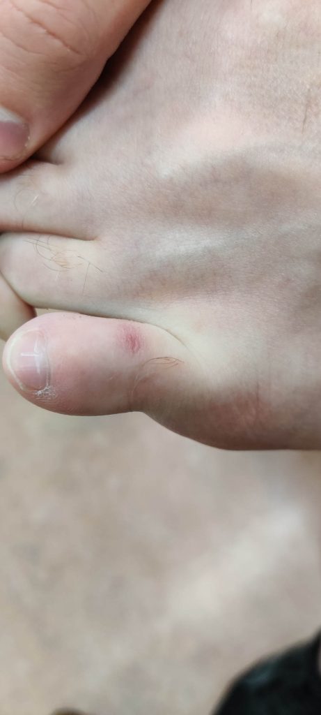 Resolved shallow ulcer on the dorsum of the toe.
