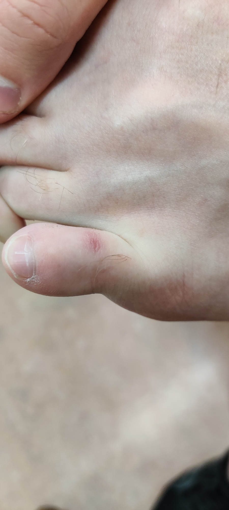 Resolved shallow ulcer on the dorsum of the toe.