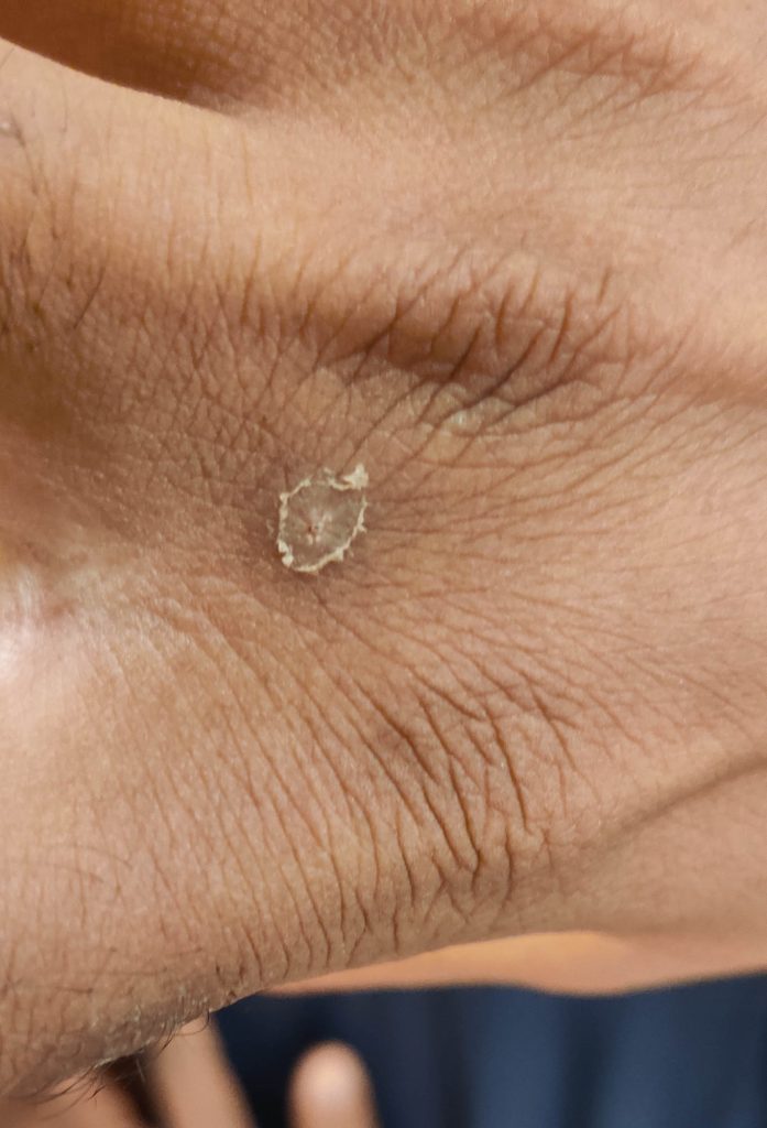 Healing interdigital ulcer.