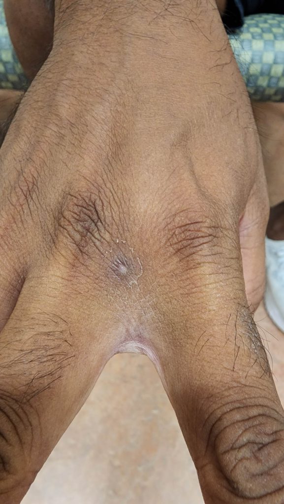 Resolved interdigital skin lesion.