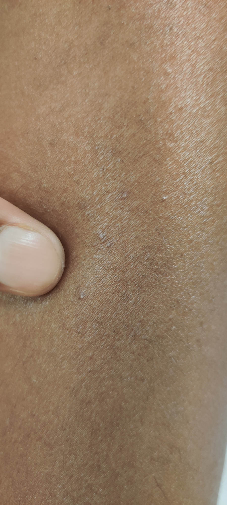 Pinpoint pustule on arm