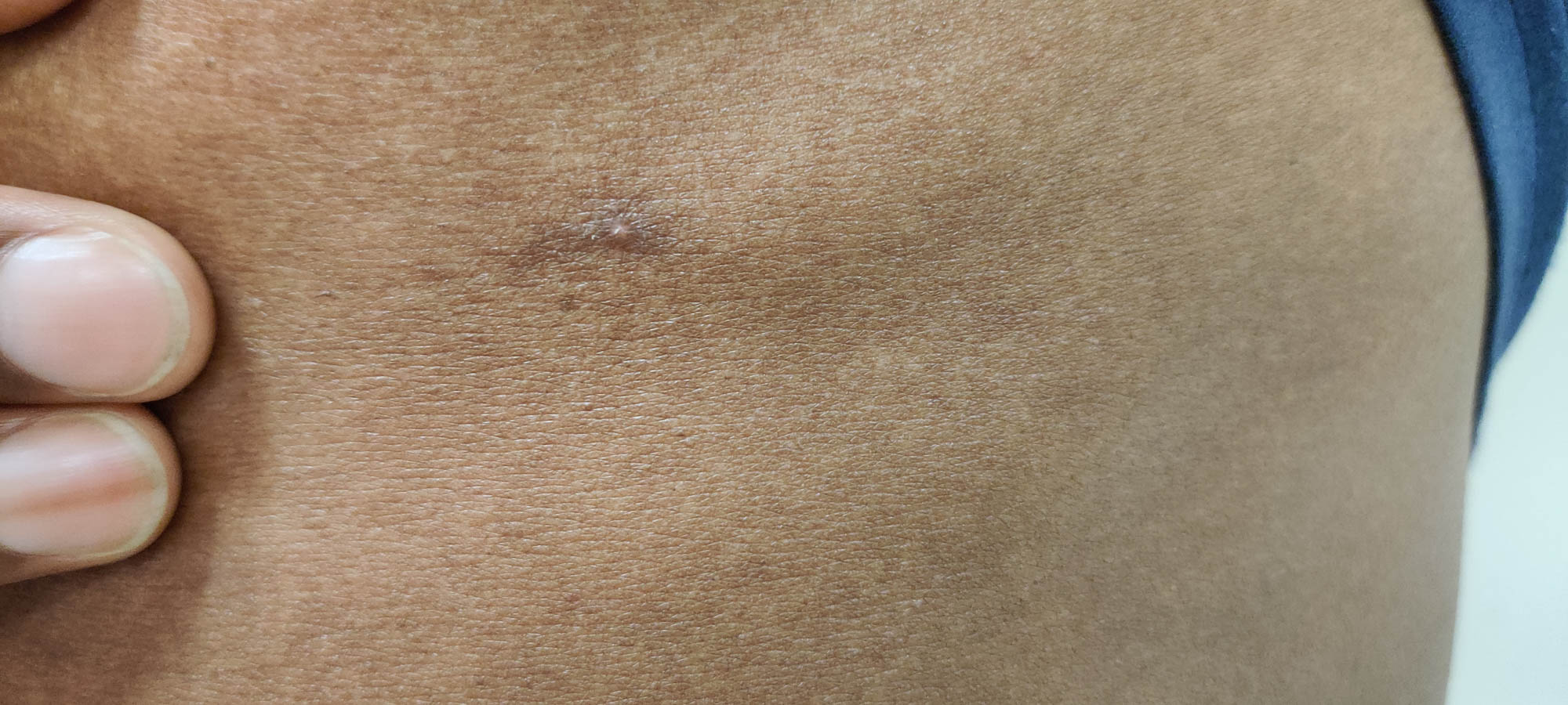 Pinpoint pustule on thorax