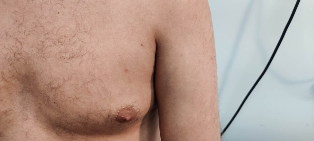 Pinpoint pustule on chest