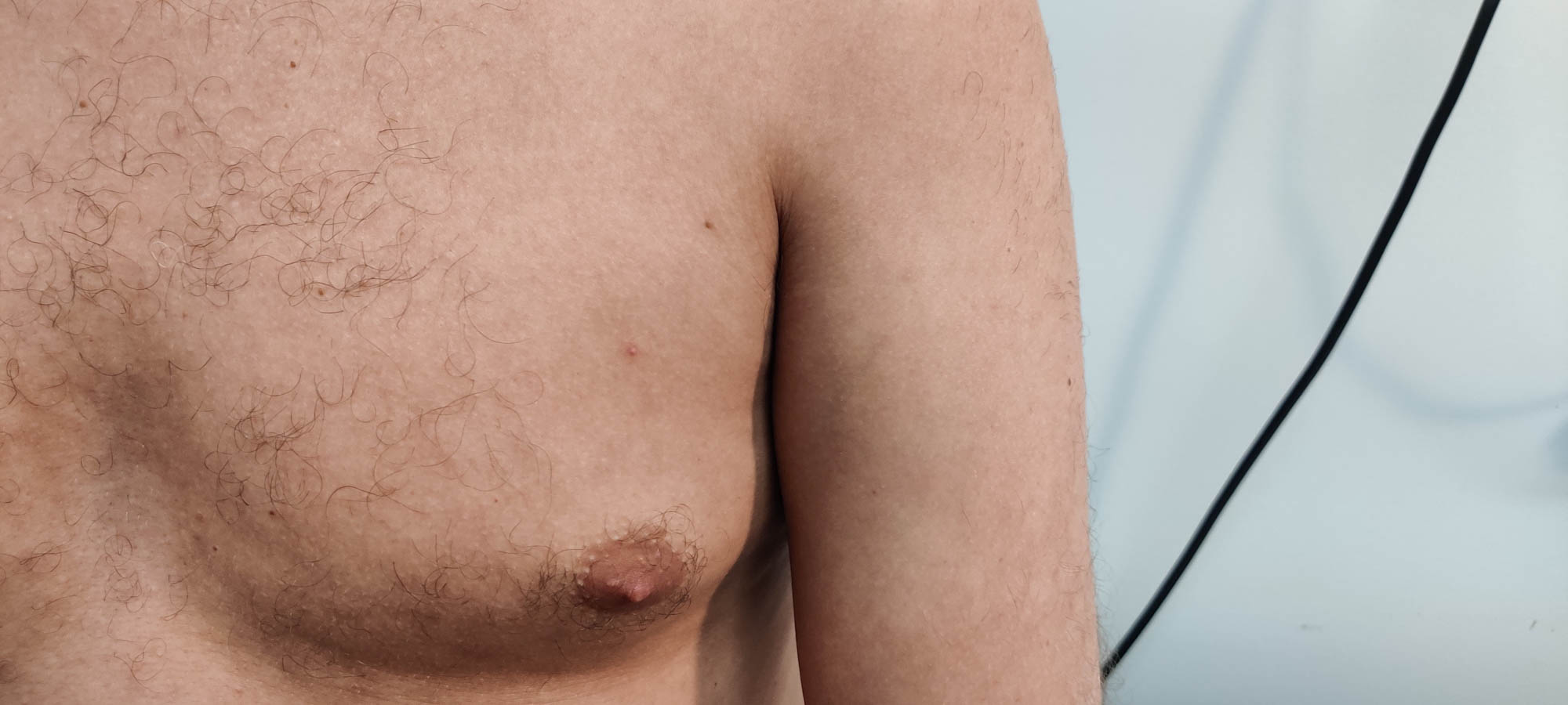 Pinpoint pustule on chest