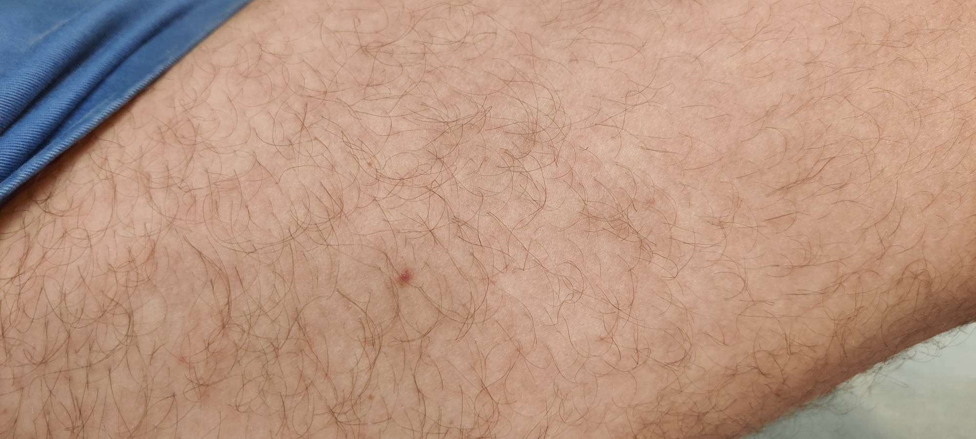 Pinpoint papule on thigh