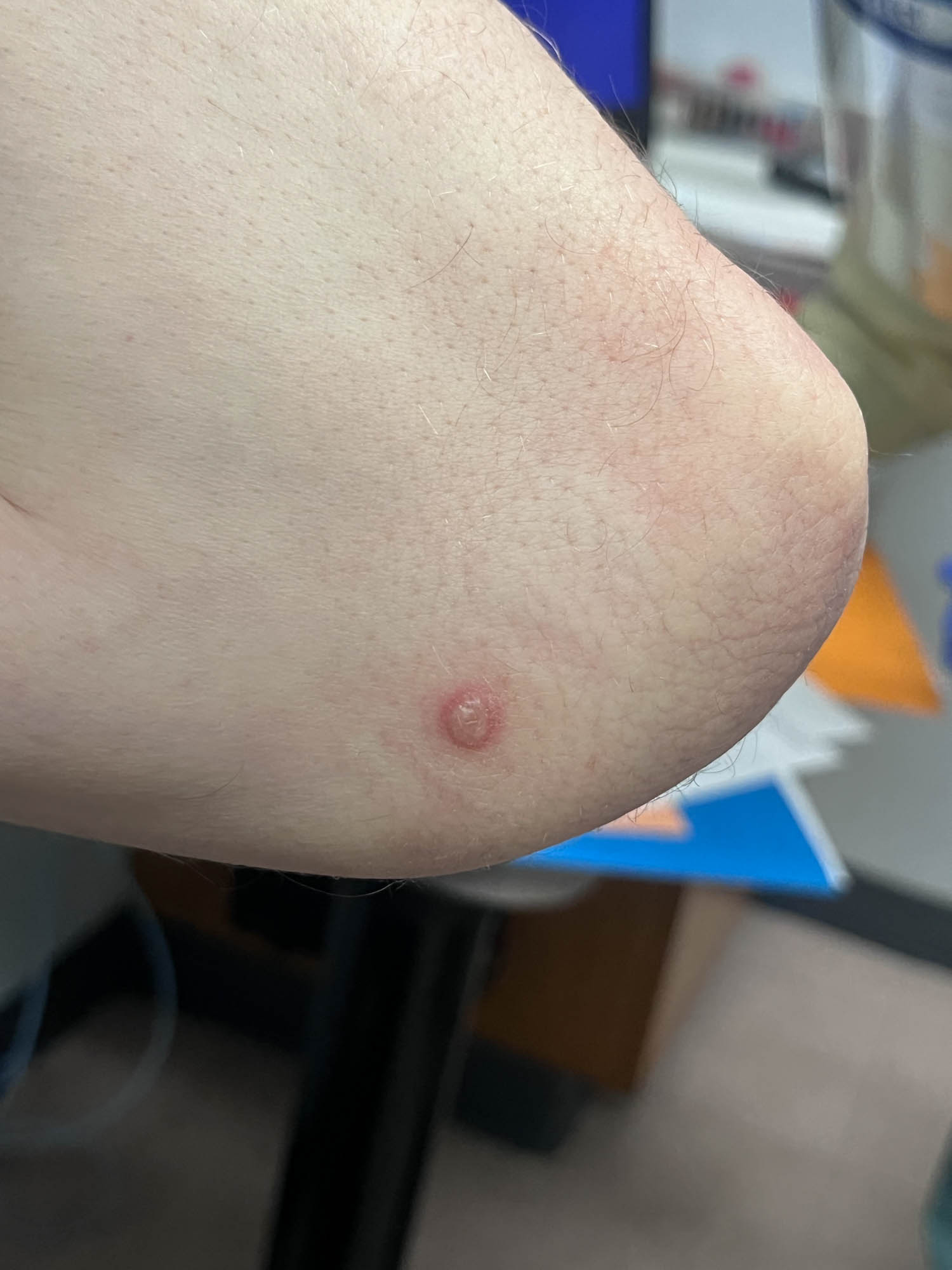 Vesicular lesion on elbow
