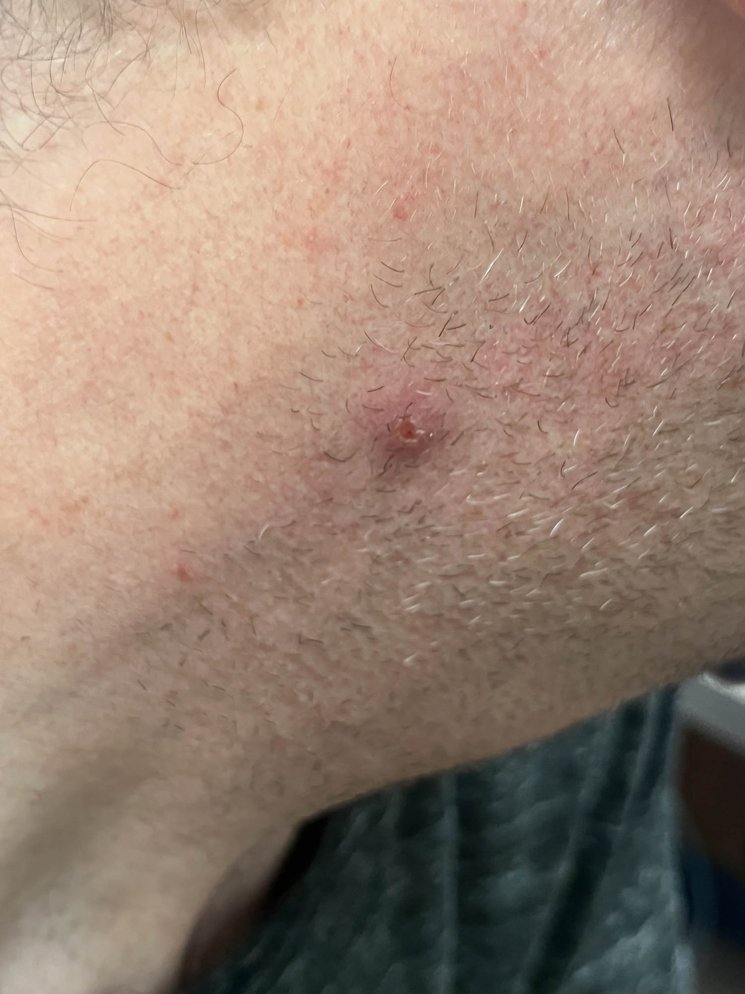 Small ulcerated papule on neck