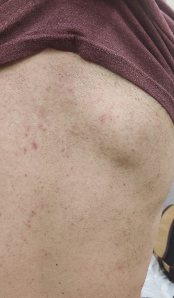 Healing excoriated maculopapular lesions on the upper back.