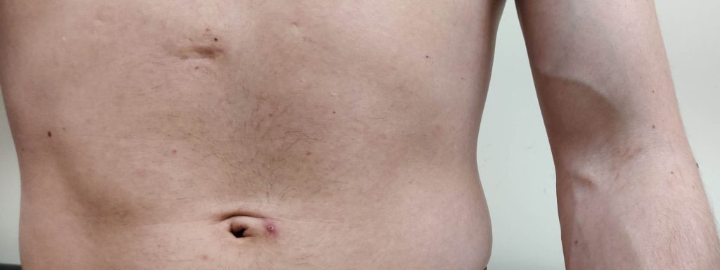 Papular lesions of varying sizes over the abdomen.