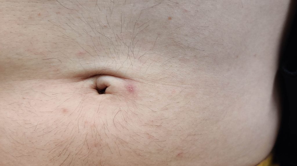 Papular lesions of varying sizes over the abdomen.
