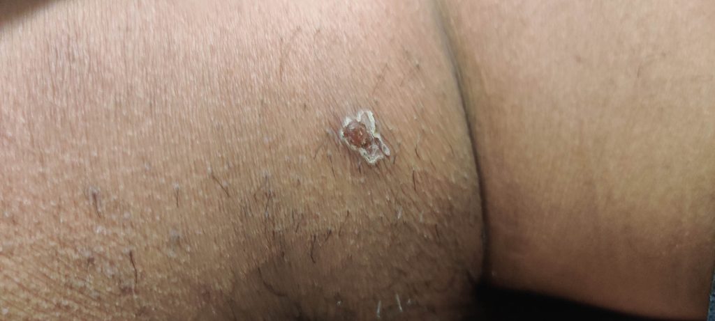 Healing buttock lesion