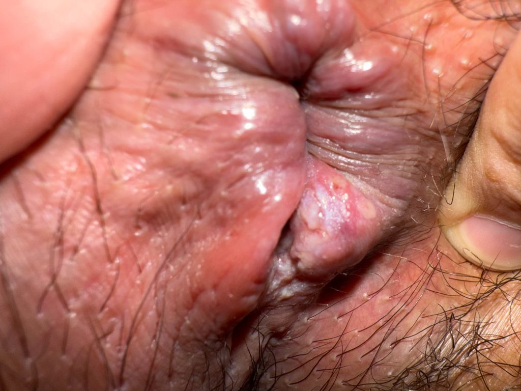 Cluster of ulcerated and pustular lesions in the perianal region