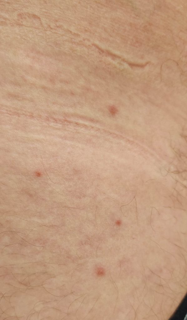 Small 2-3mm papules on the hip.