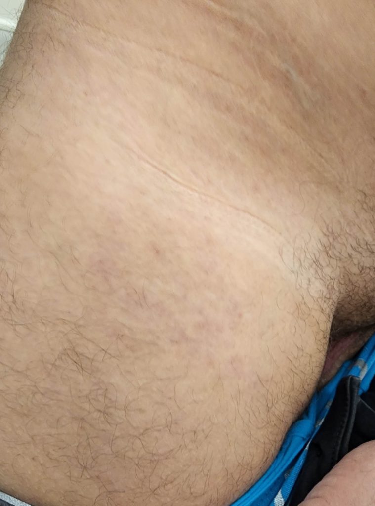 Healed skin with minimal residual hyperpigmentation at the site of former small papules on the upper leg.