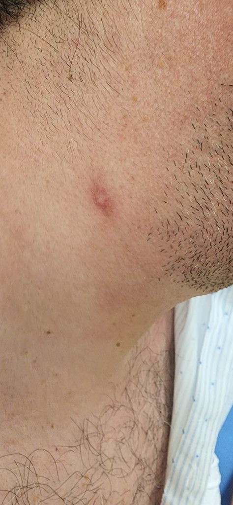 Resolving pustule on the neck.