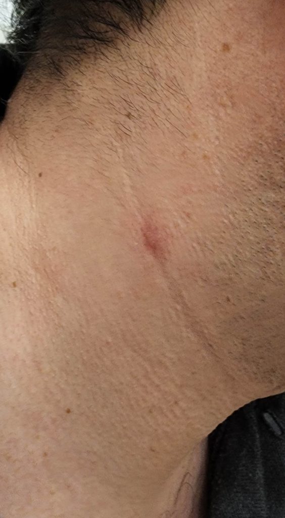 Healed pustule on the neck.