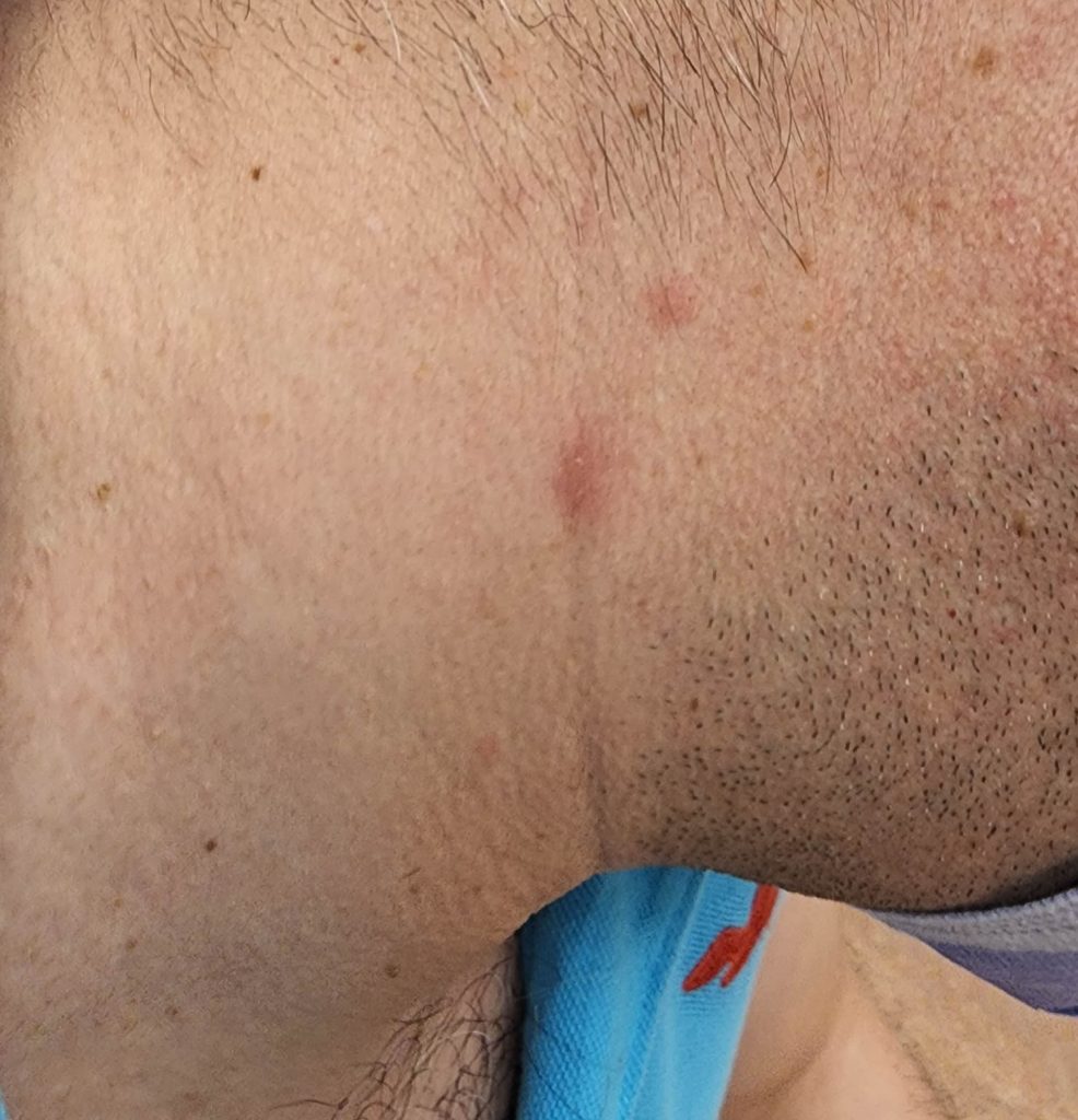 Residual hyperpigmentation on the neck.