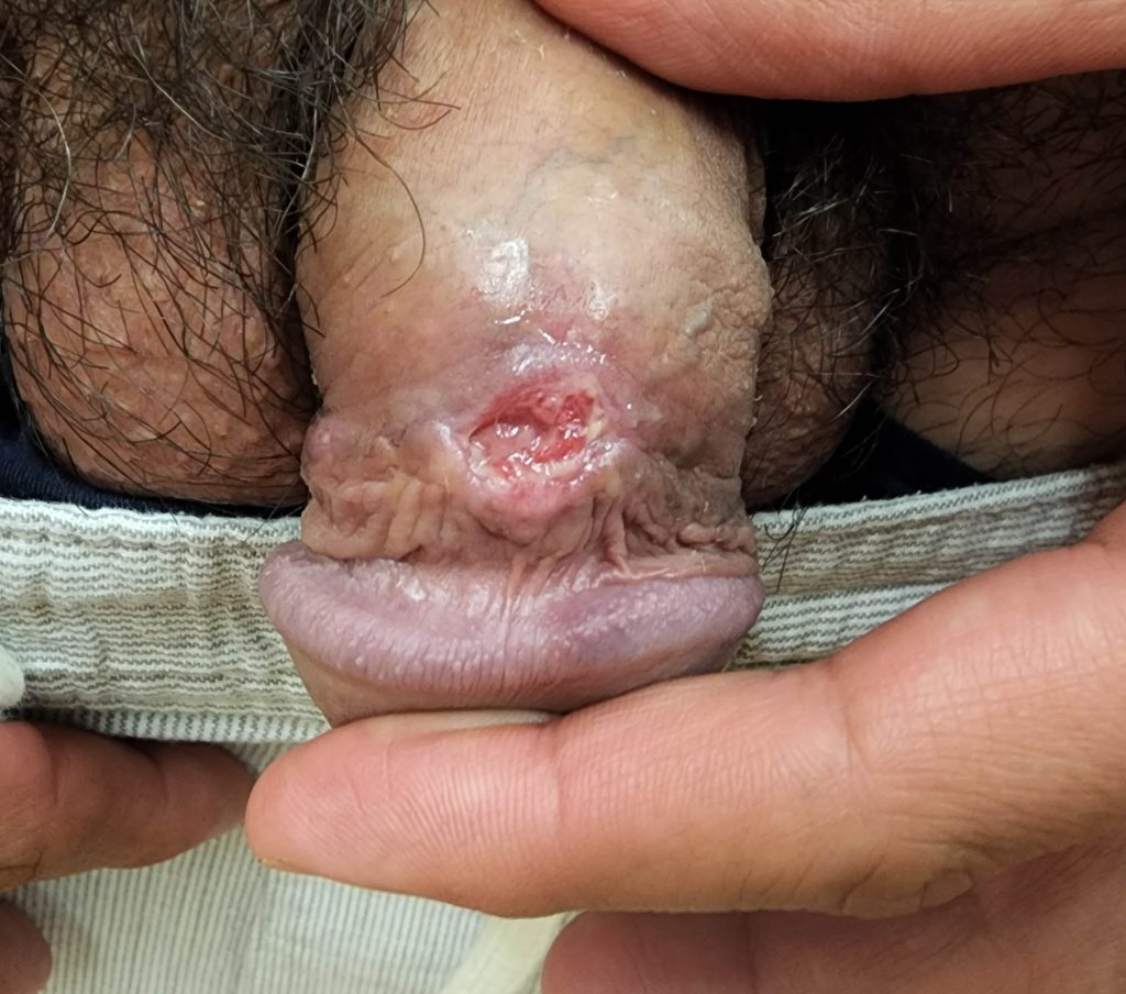 Deep ulcer on the shaft of the penis.