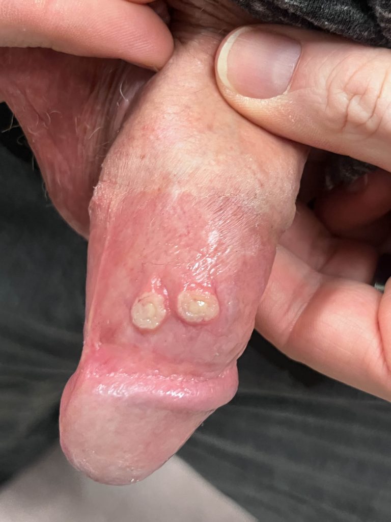 Prominent pustular lesions with early central umbilication on the shaft of the penis.