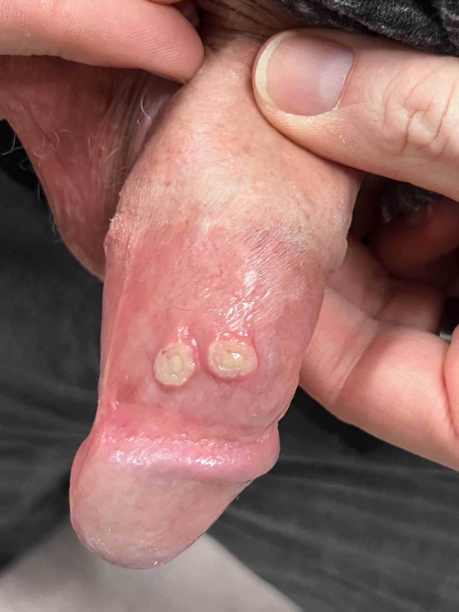 Prominent pustular lesions on shaft of penis