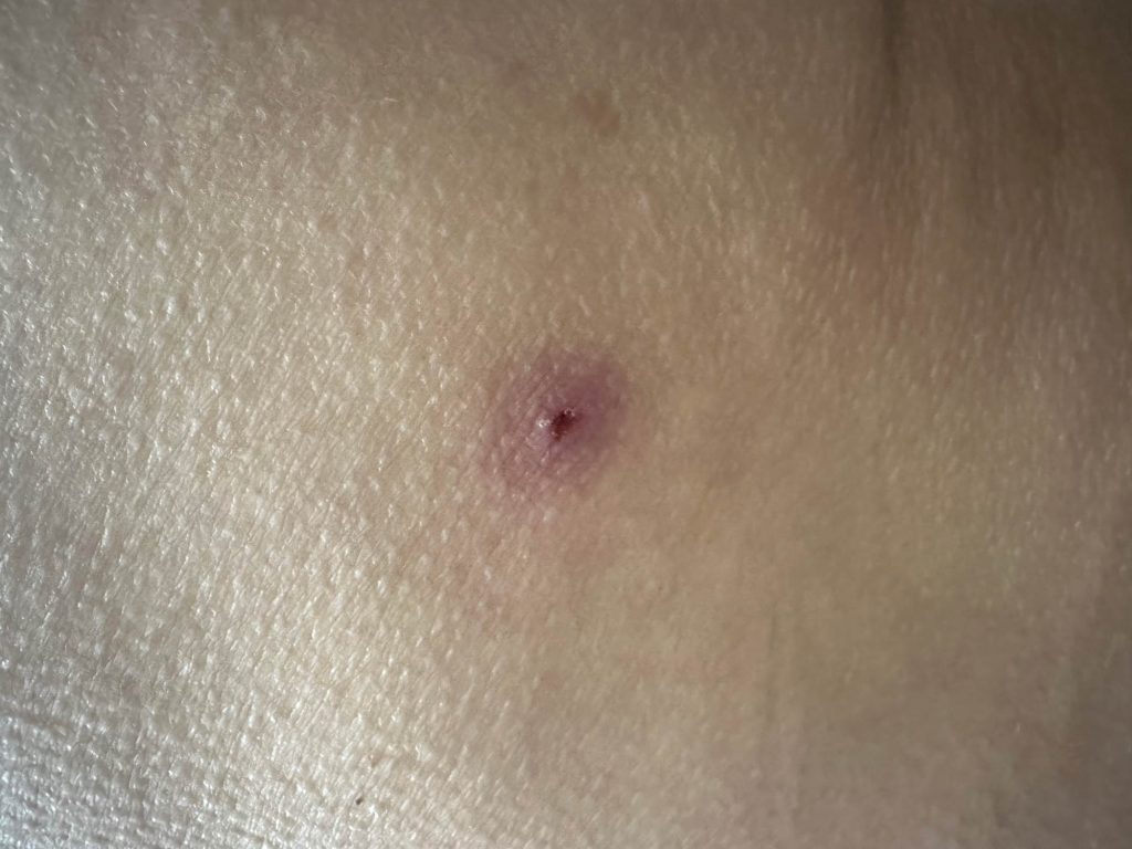 Partially scabbed ulcerative lesion on the buttock