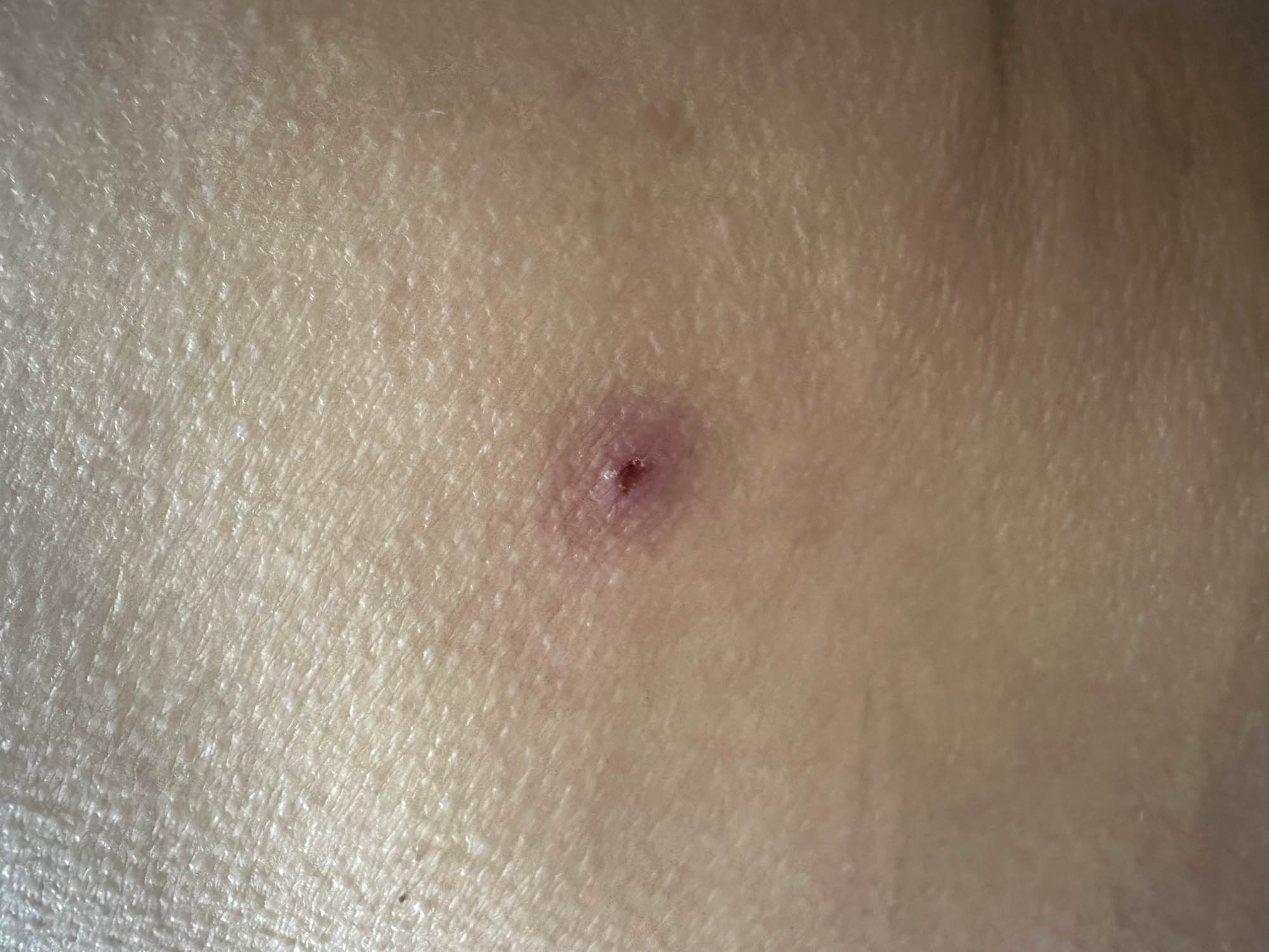 Partially scabbed ulcerative lesion on the buttock