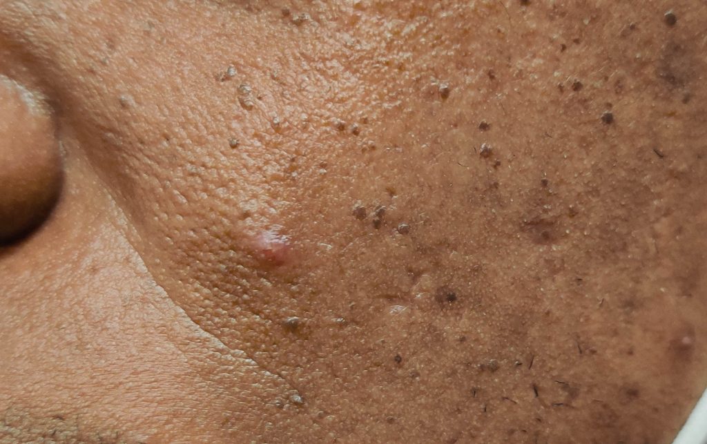 Papule on the cheek.