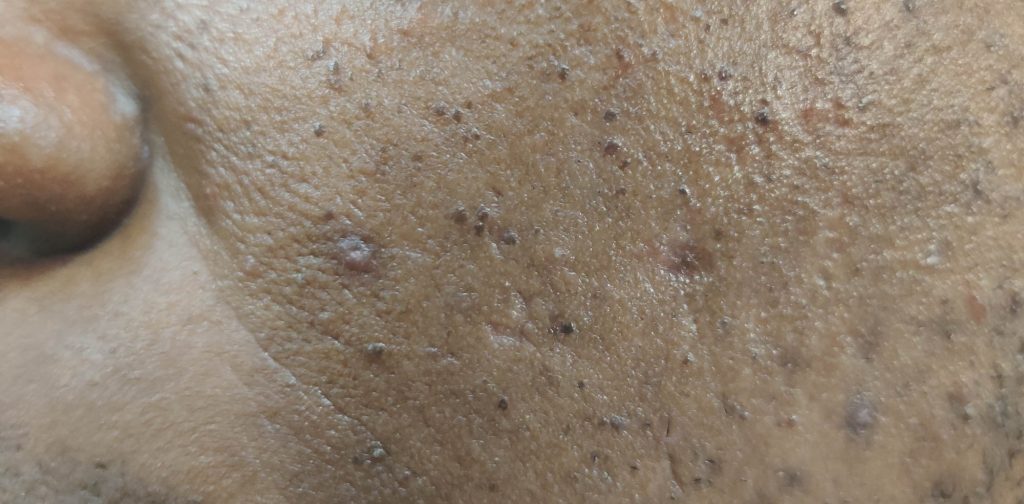 Healing ulcer on the cheek.