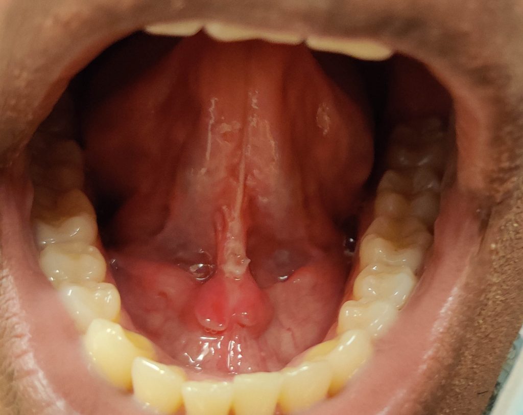 Ulcer on the frenulum of the tongue