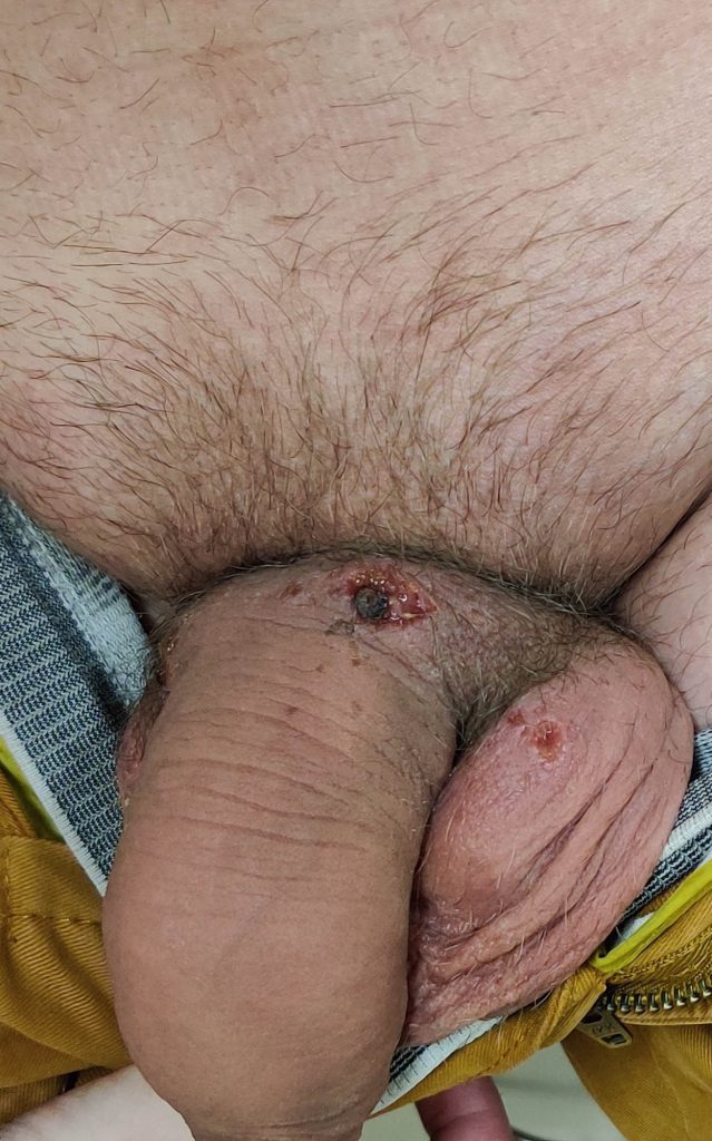 Open ulcers at the base of the penis and on the left scrotum.