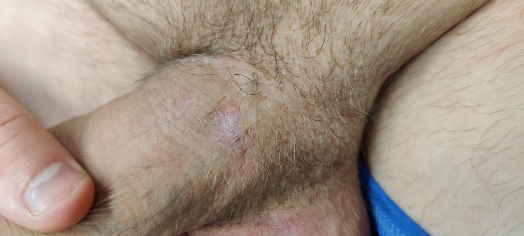 Fully healed genital ulcer.