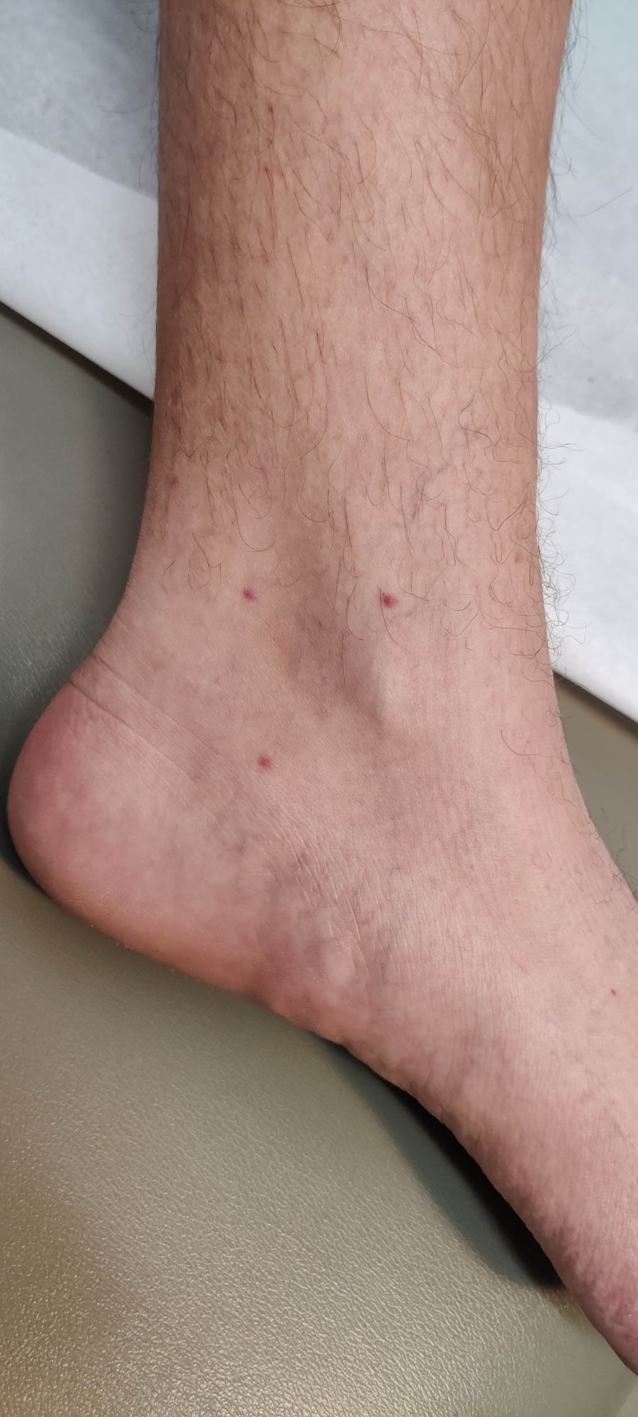 Papules on the foot of a 38 year old cisgender man