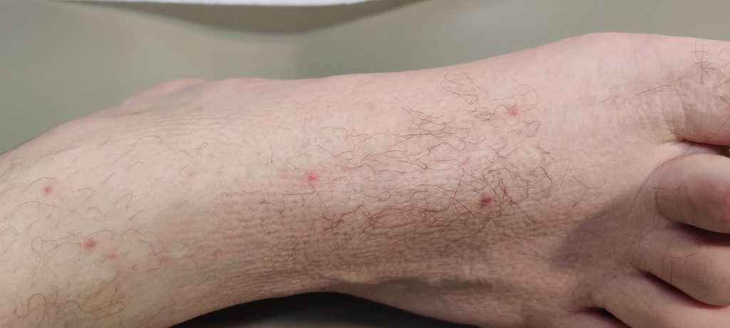 Erythematous papules on the foot of a 38 year old cisgender man