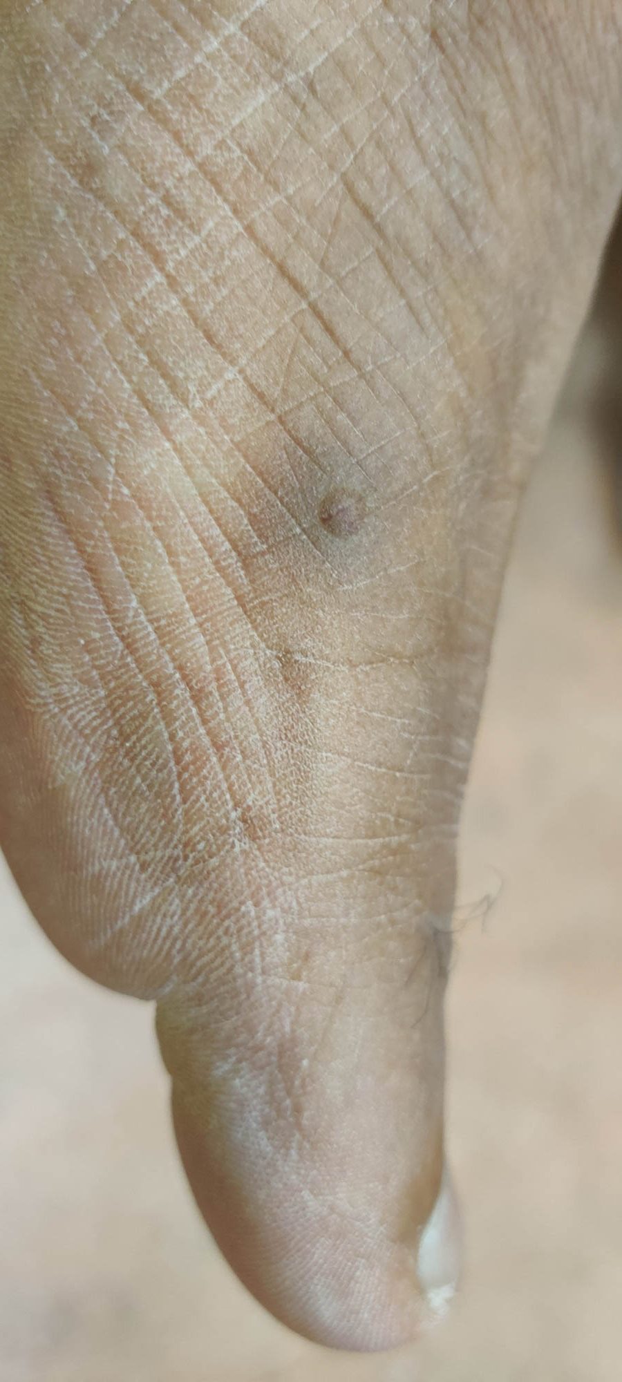 Hyperpigmented papule on the left foot.