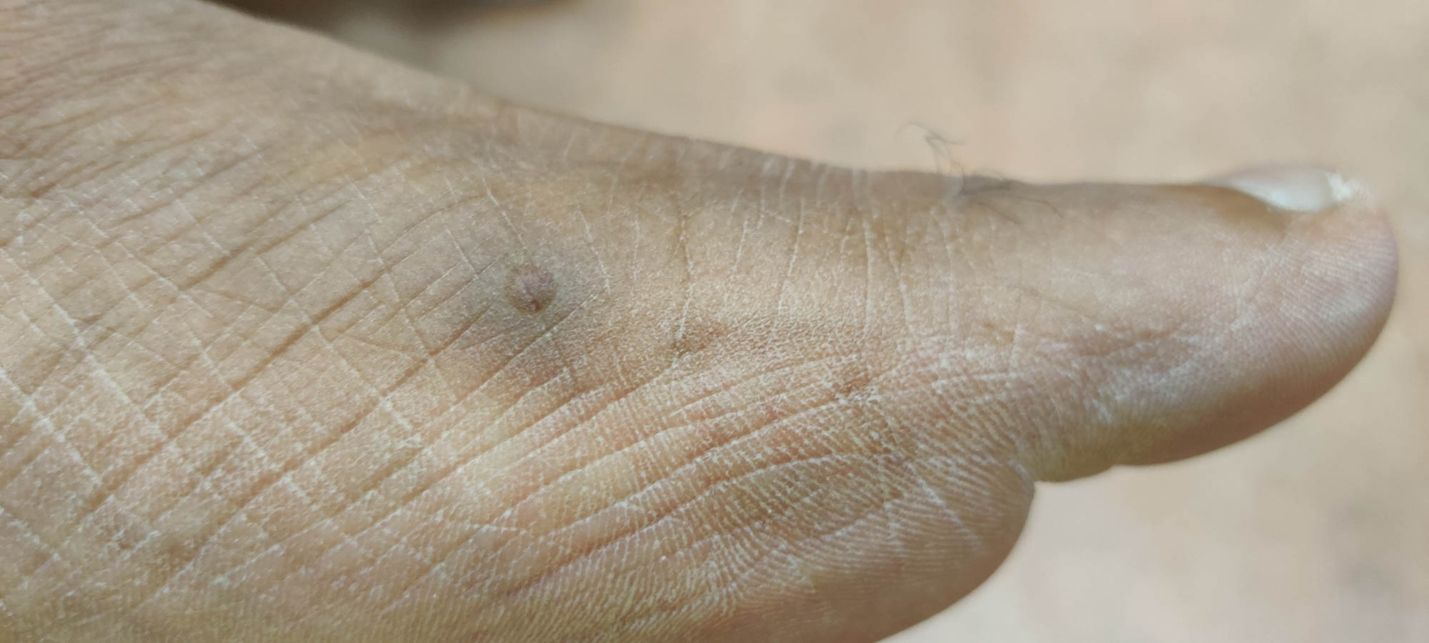 Hyperpigmented papule on the left foot 1 of 3