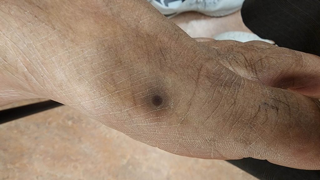 Scabbed papule on the left foot.