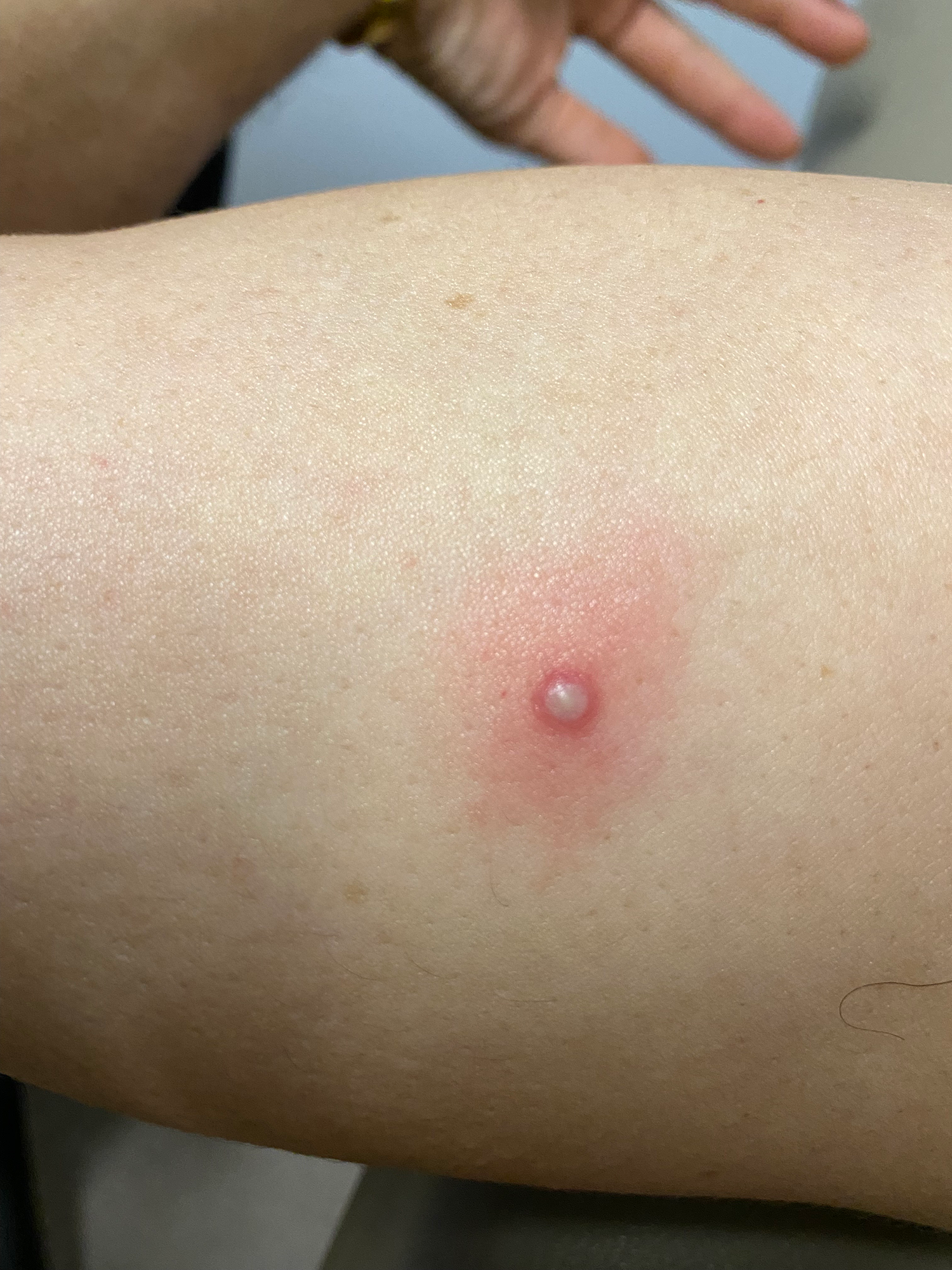 Vesiculopustular lesion on upper arm 2