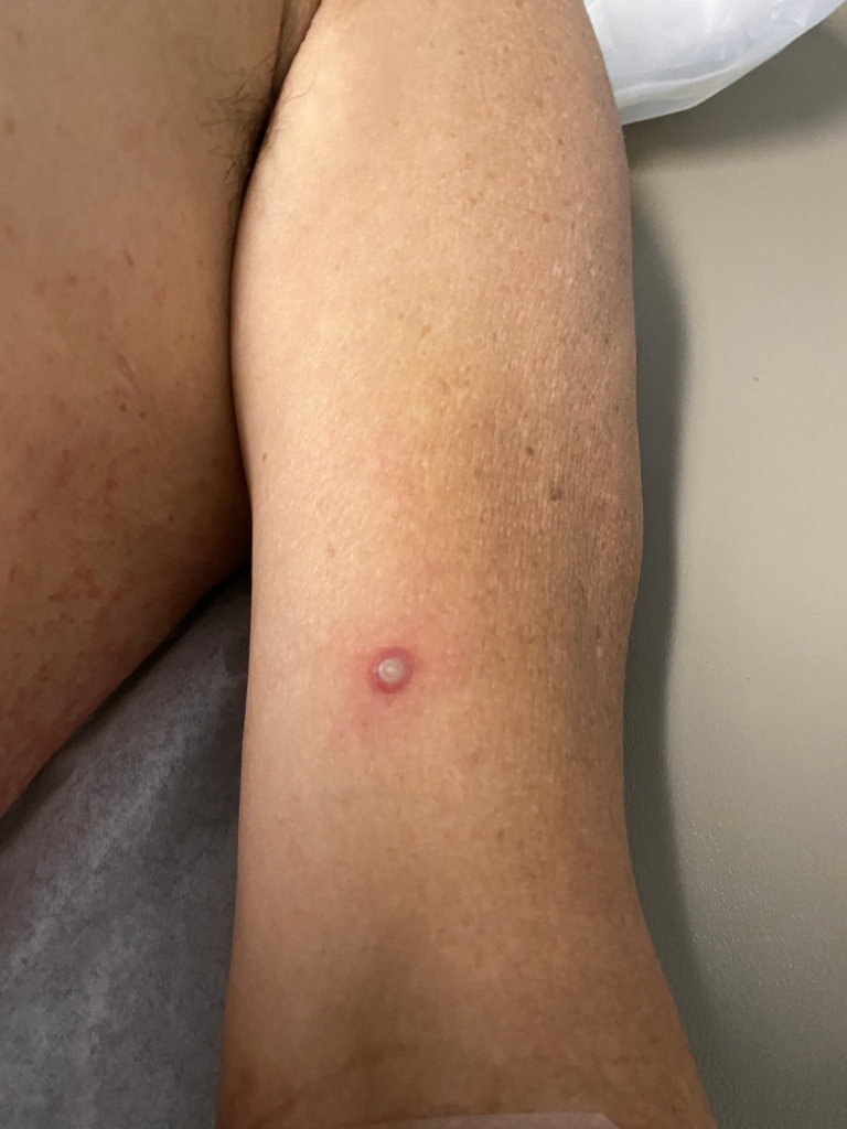 Vesiculopustular lesion on upper arm 1