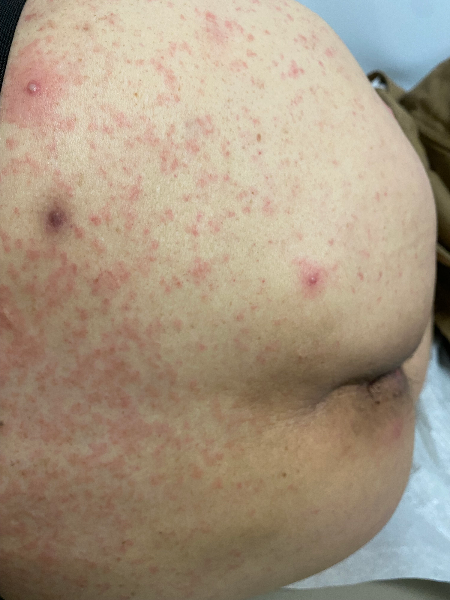 Maculopapular rash on lower back and buttocks