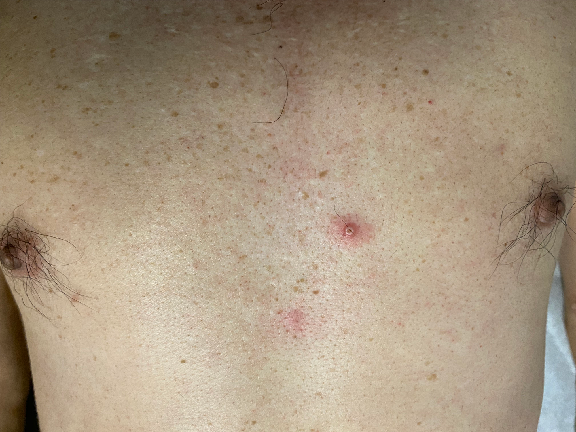 Chest pustule
