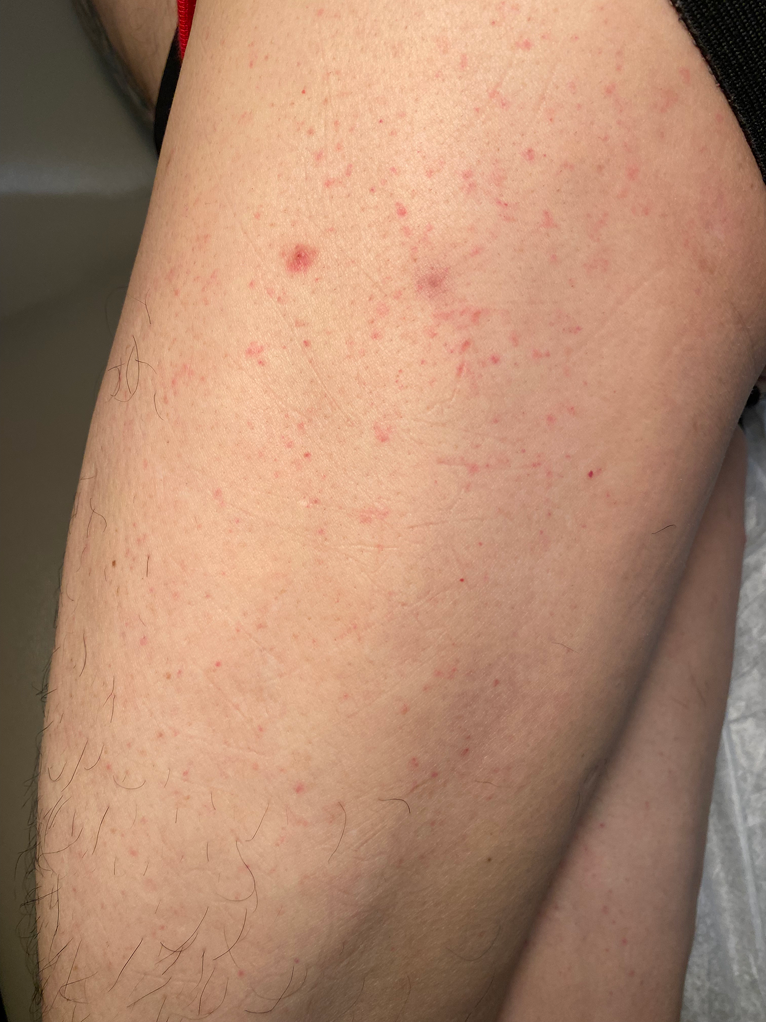 Papules on the left thigh